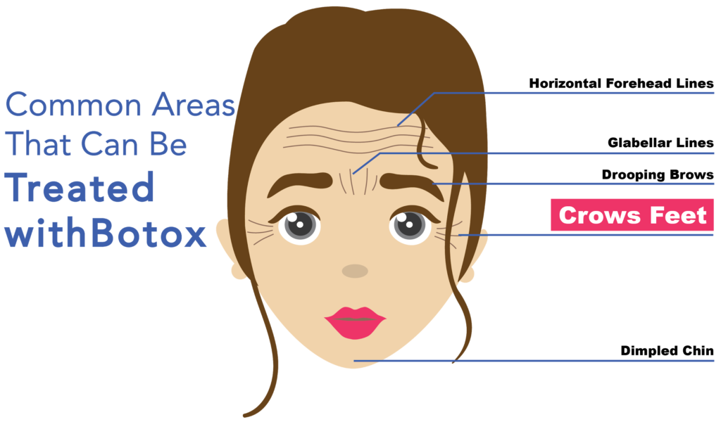 common areas that can be treated with botox