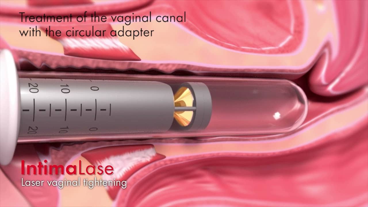 laser vaginal rejuvenation