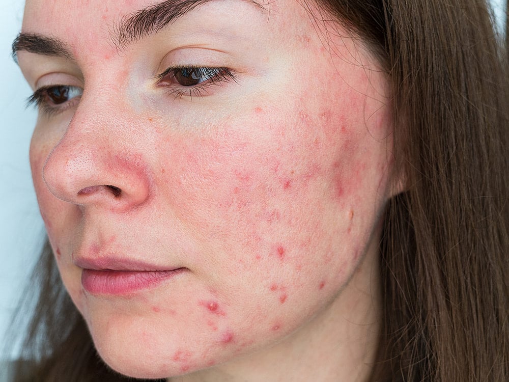 How to Prevent Rosacea