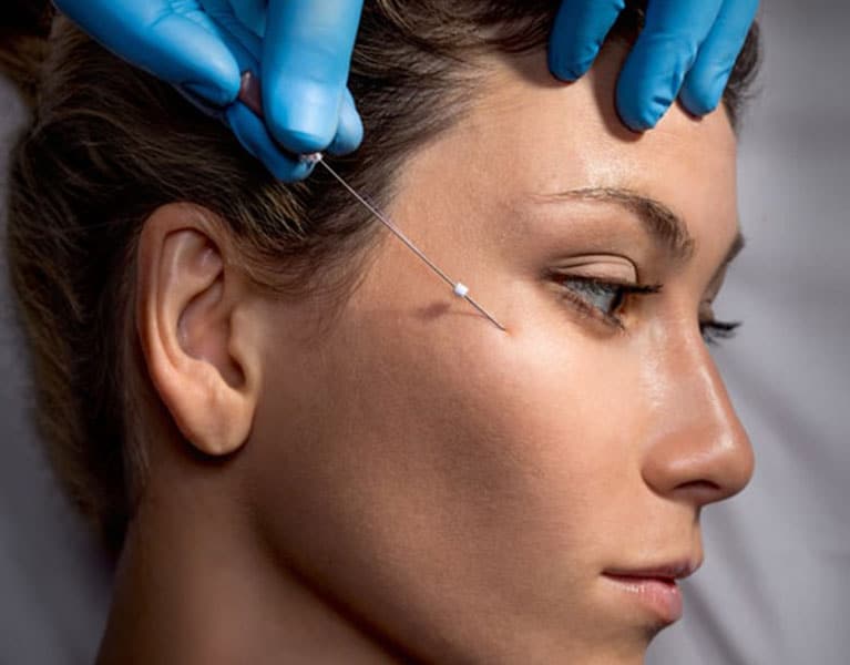 Face Thread Lift Singapore VShape Face Lifting Youthful Appearance