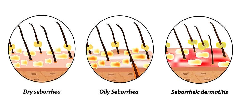 types of seborrhea