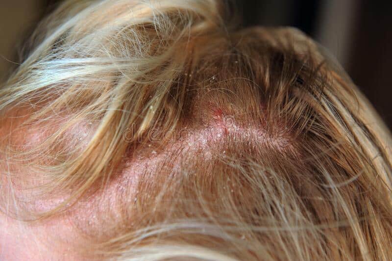 Contact Dermatitis from Hair Products and Styling Habits