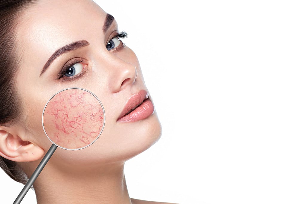 All About Rosacea Explained
