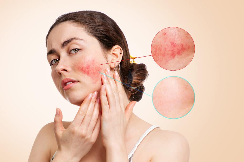 Four Types of Rosacea