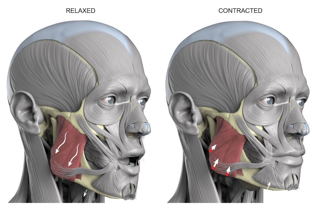 What is Jaw Reduction Treatment