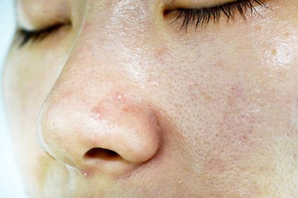 acne bumps