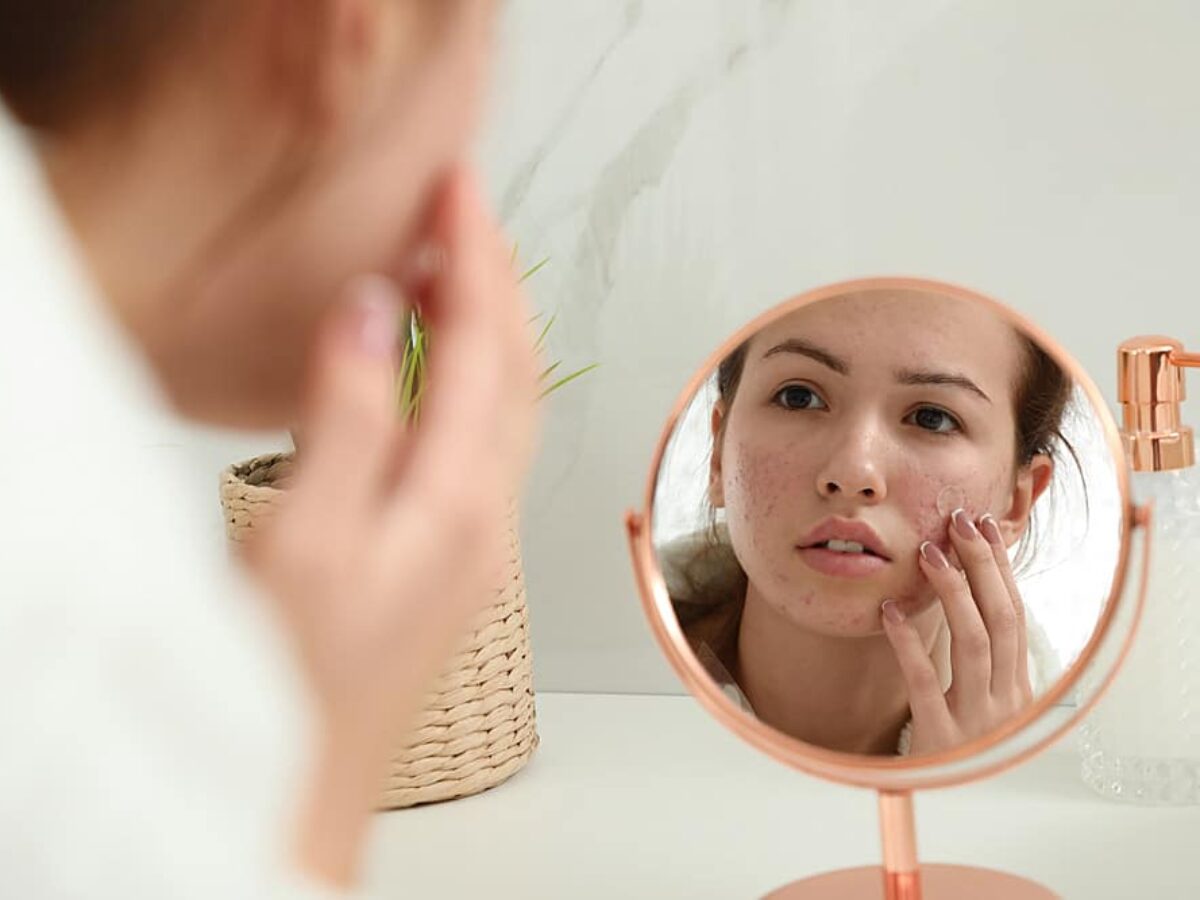 The 3 Types Of Acne Scars And How To Treat Them