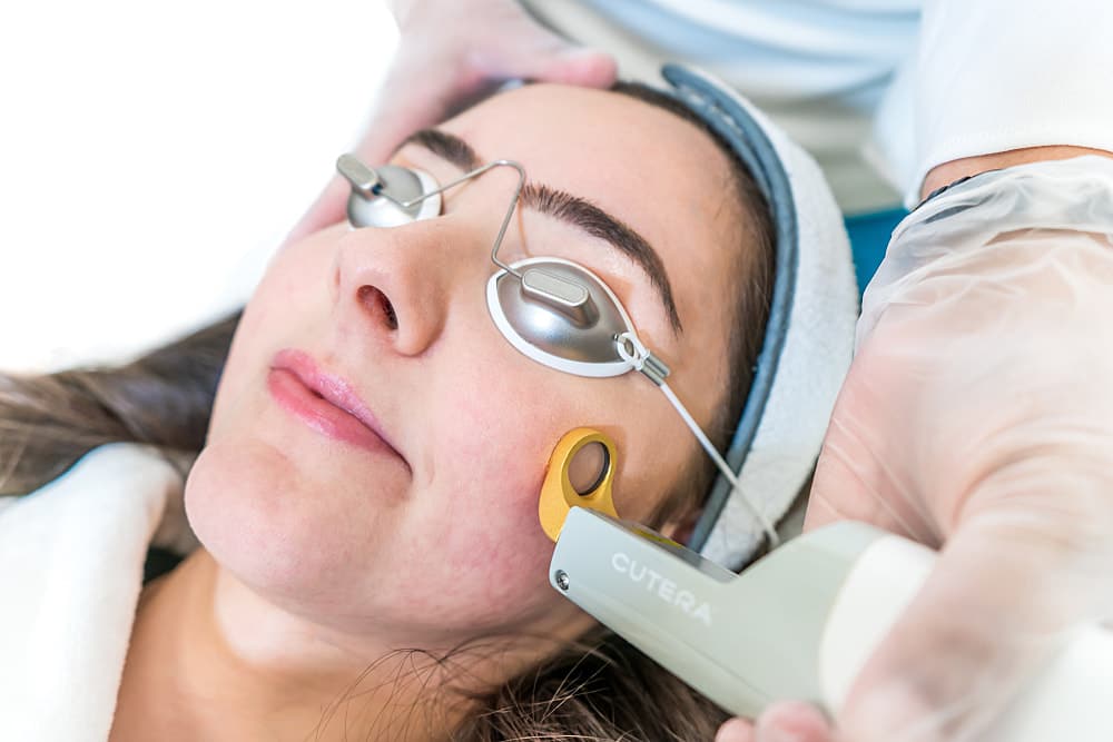 Laser Treatments to Remove Acne Scars
