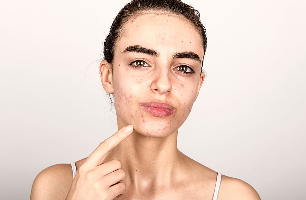 When to Seek Professional Help for Your Acne