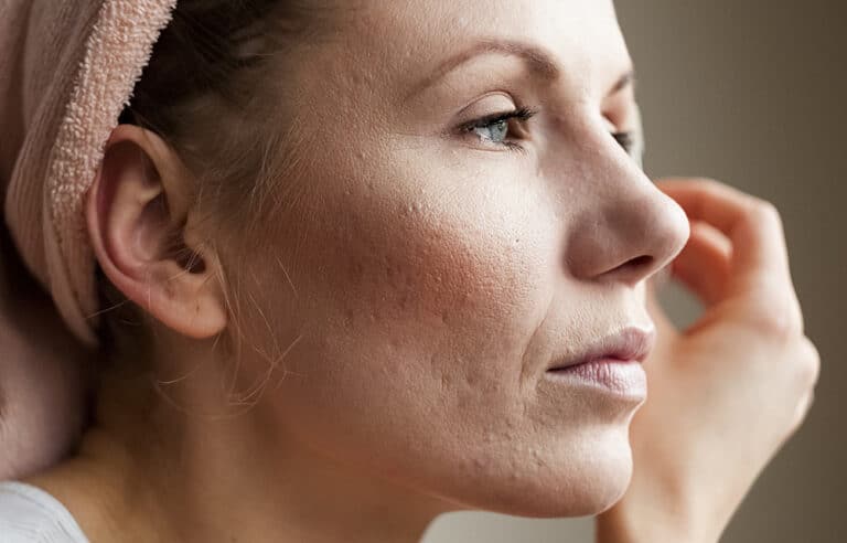 Are Acne Scars Permanent The Truth About Acne Scars