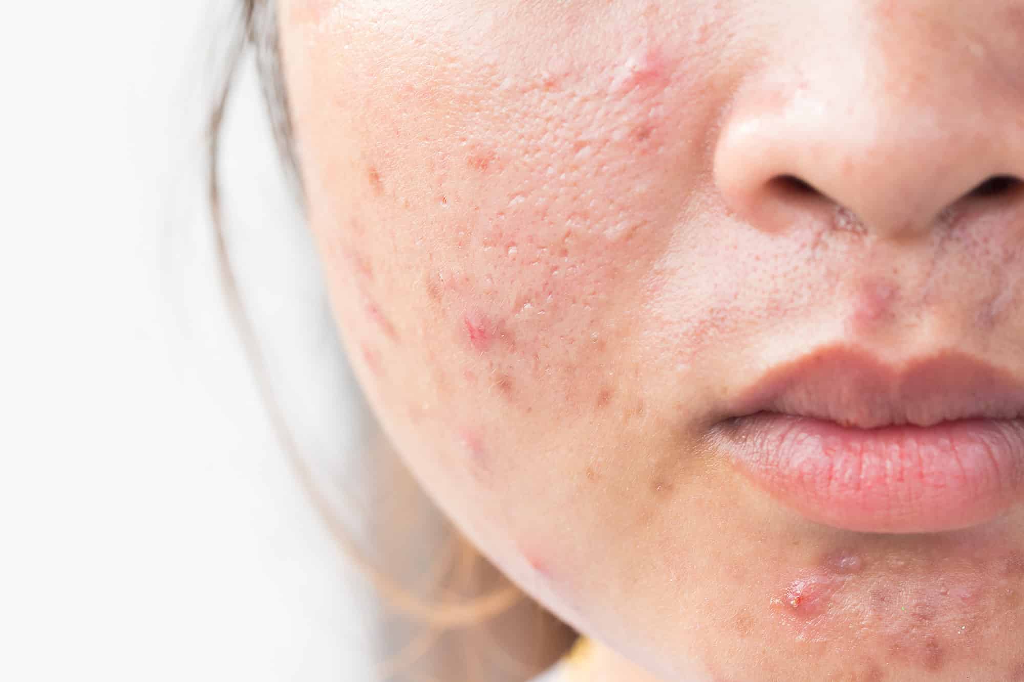 Rosacea is known for looking red and blotchy, which is why it can be mistaken as acne