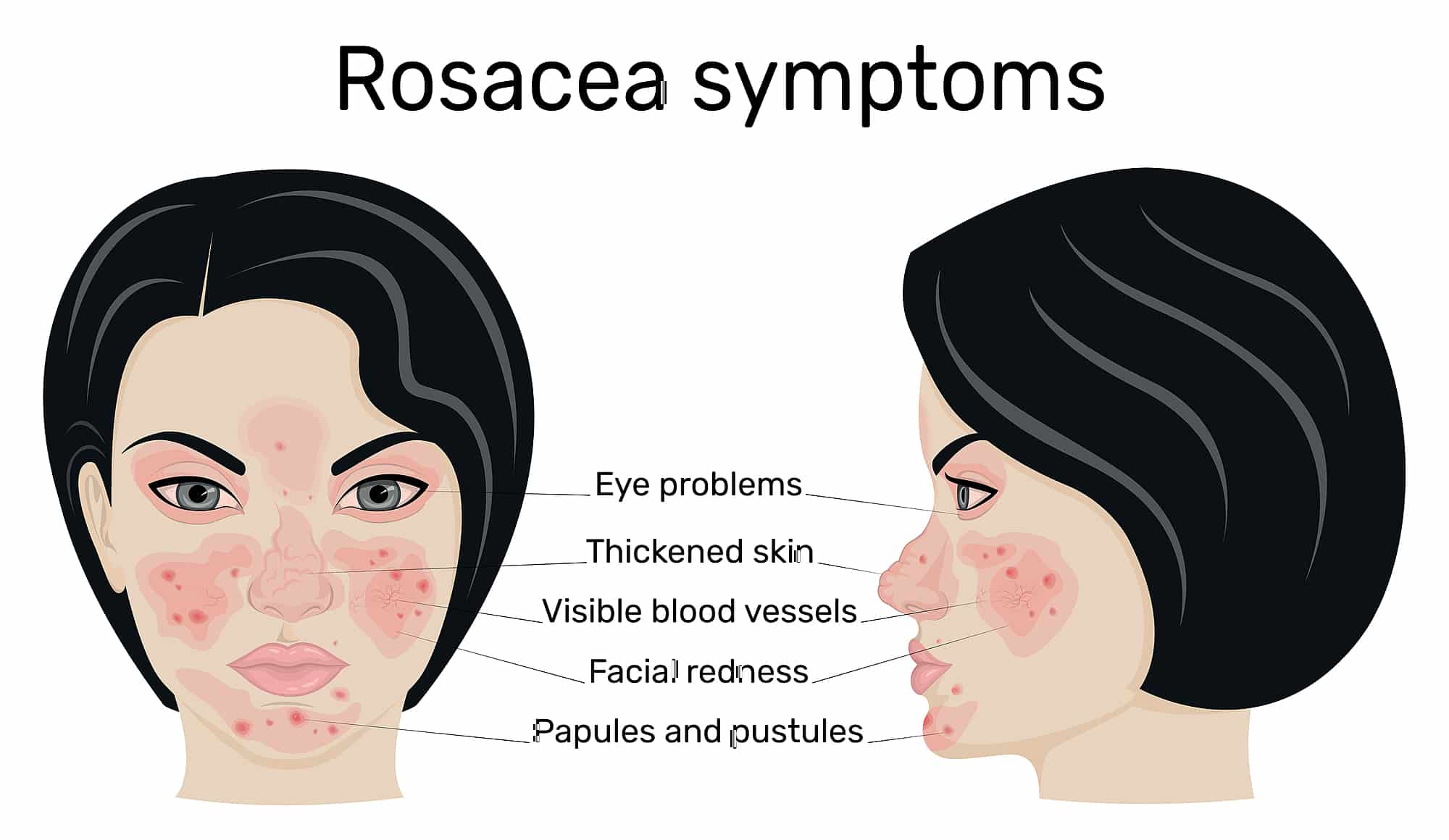 Some examples of rosacea symptoms to look out for