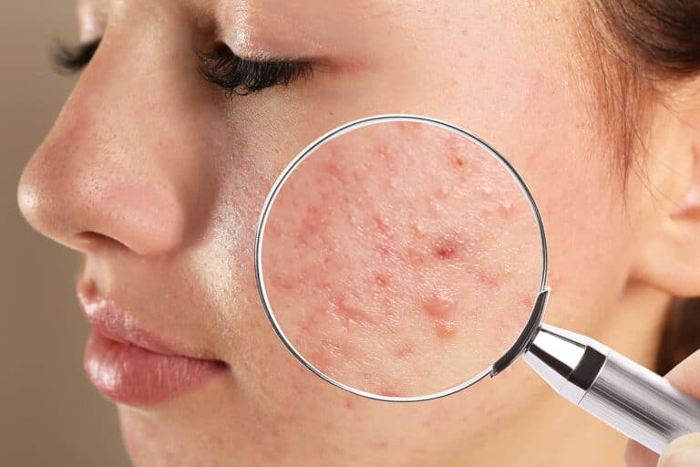 cystic acne treatment in Singapore