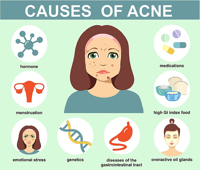 Causes of Cystic Acne