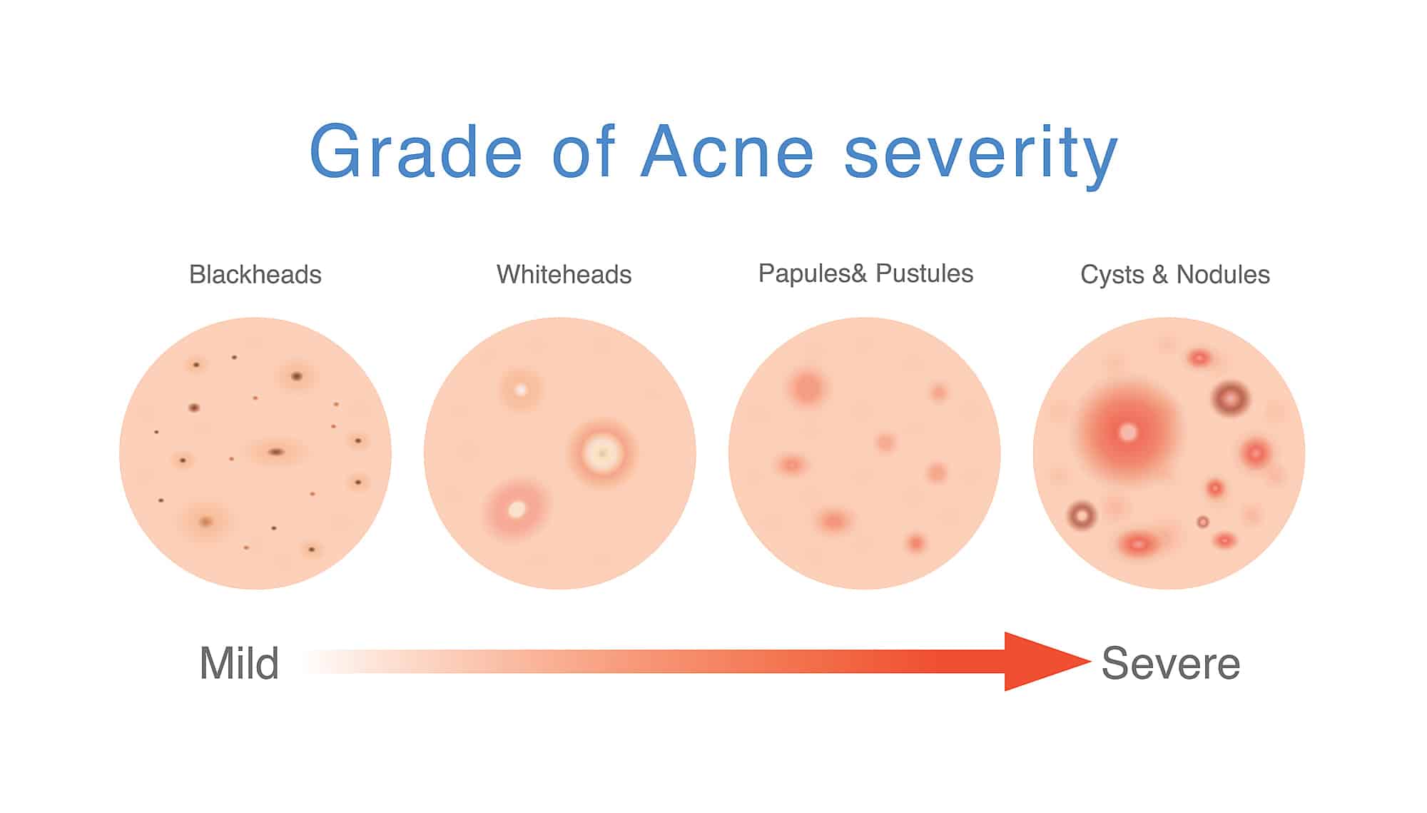 Grade of Cystic Acne
