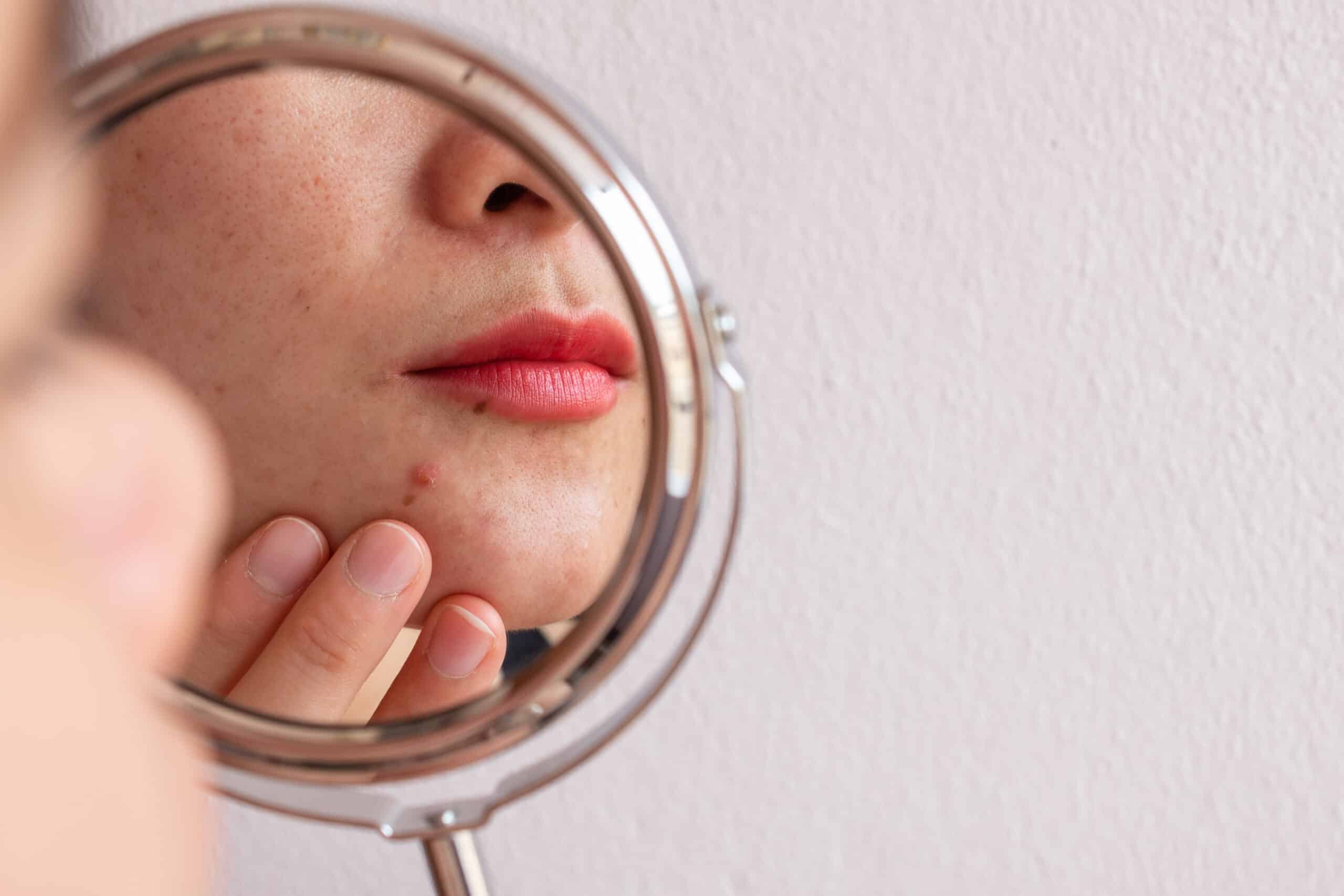 Should You Use An Acne Patch