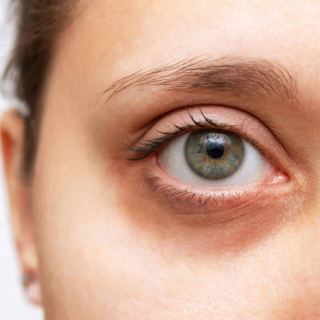Tear Trough Fillers: Who Should Get it and After-care Tips