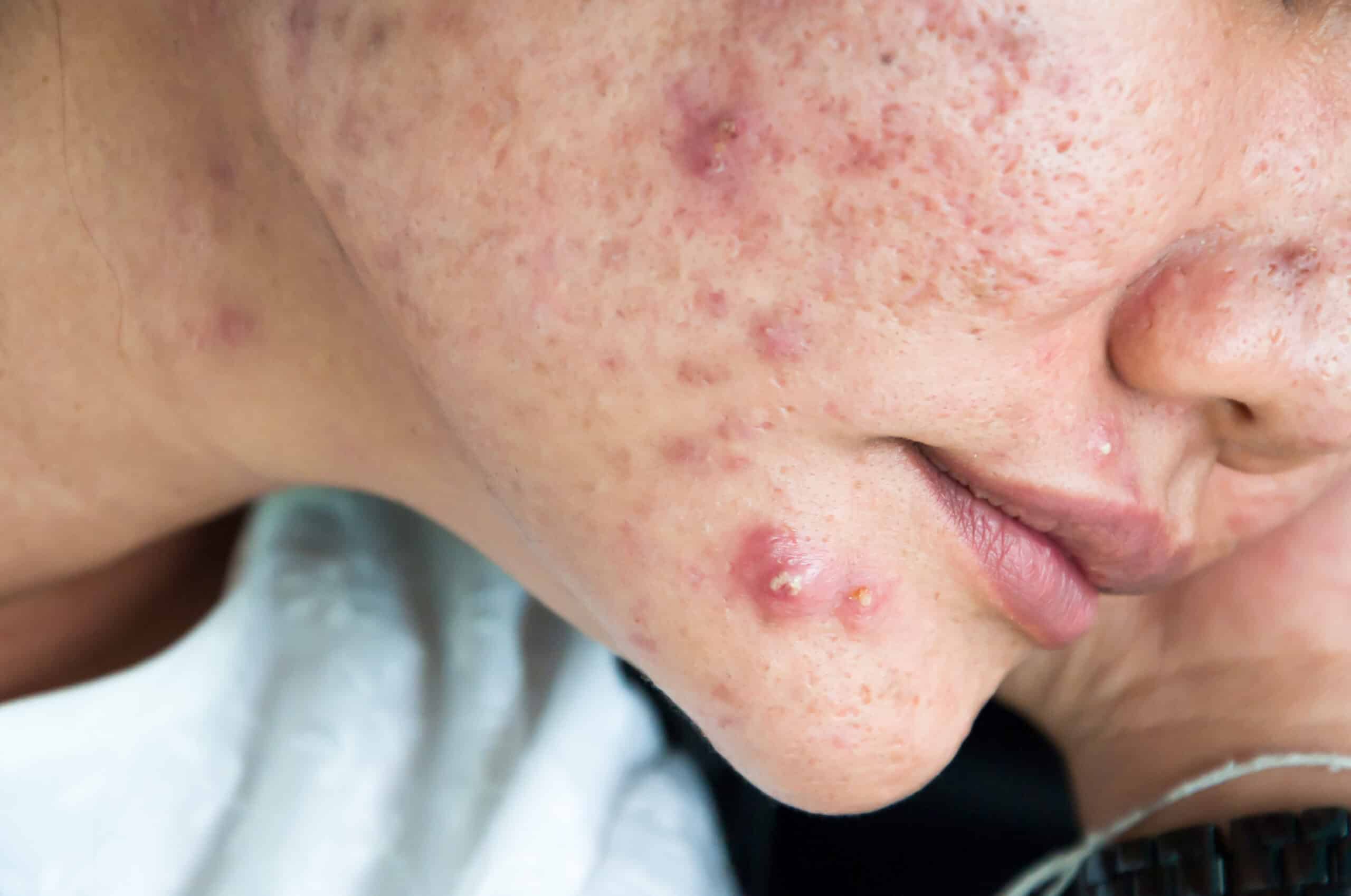 When are acne patches ineffective