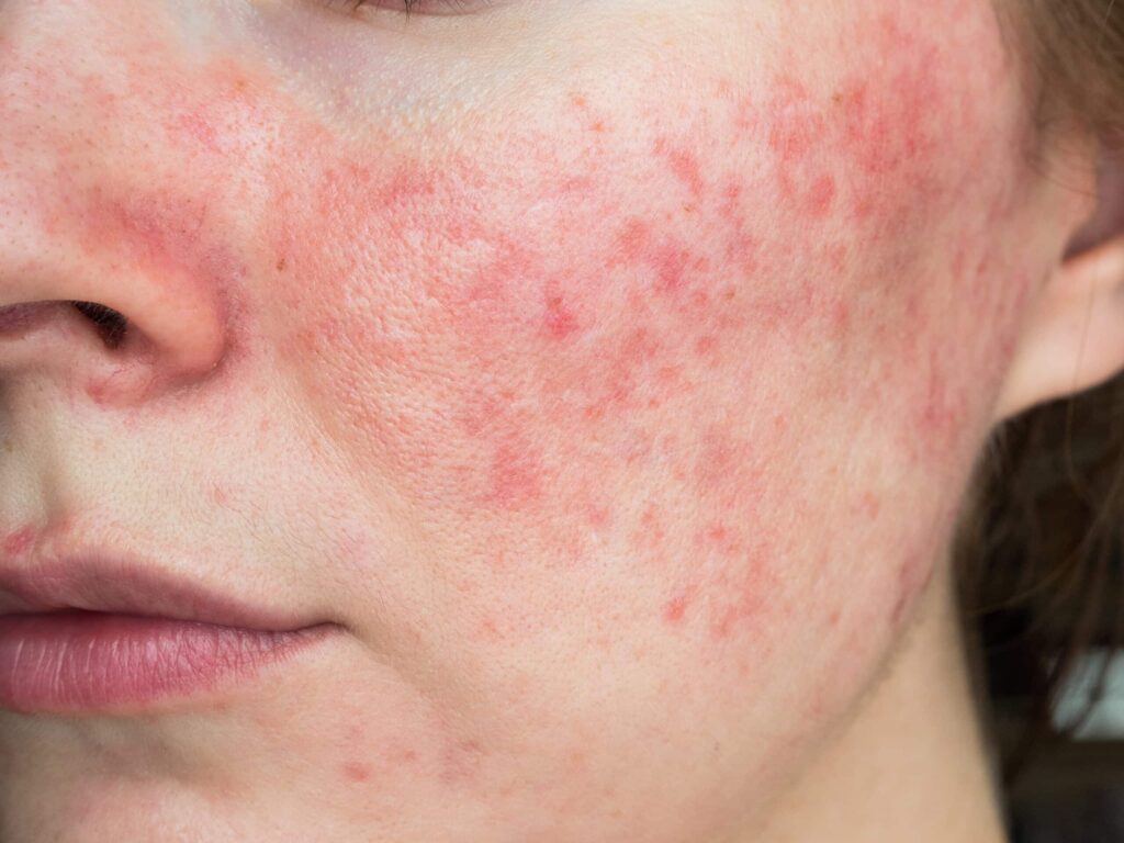 9 Skincare Ingredients That Could Worsen Rosacea