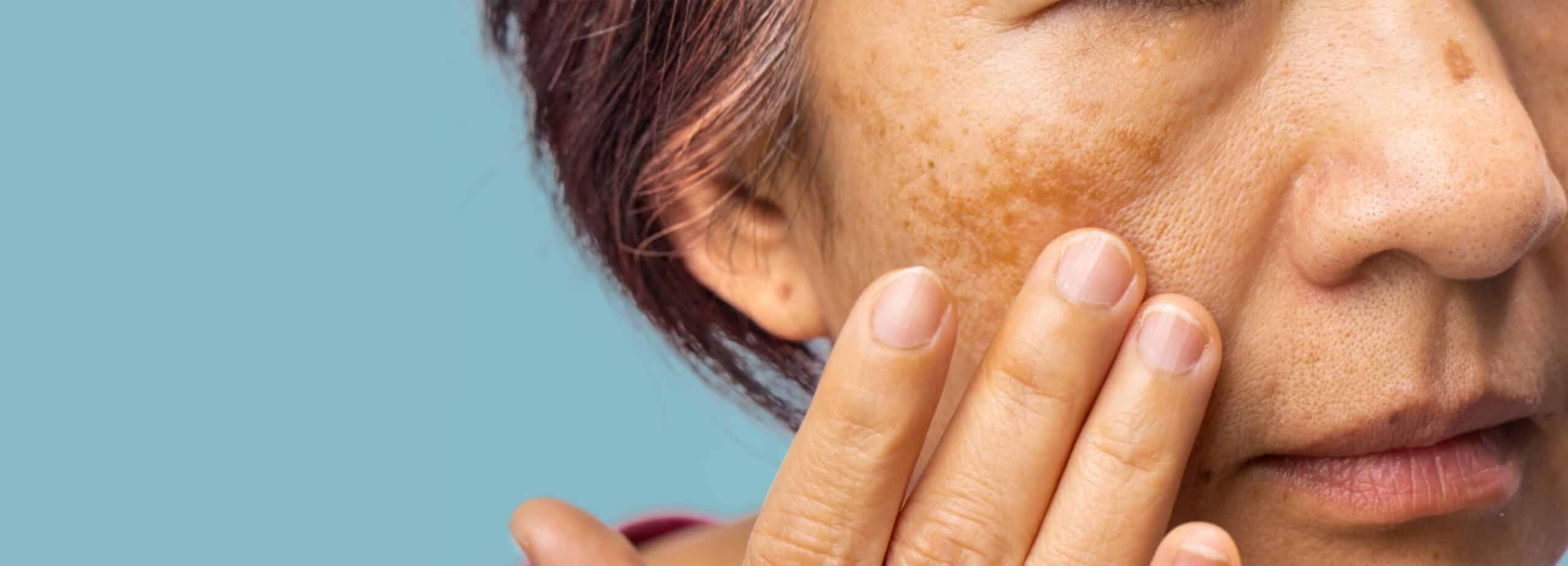Factors that increase the risk of developing melasma