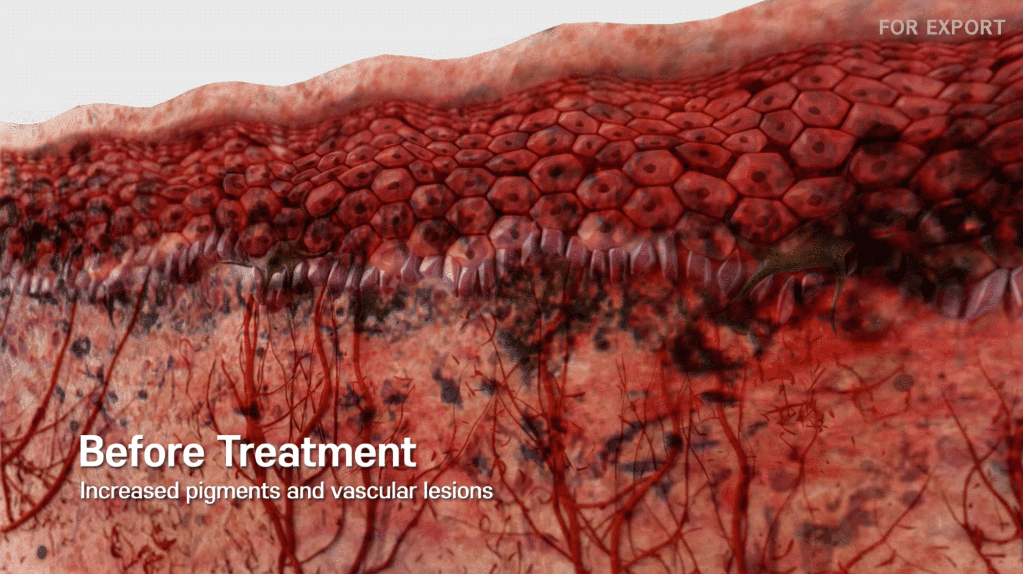 Before RF Microneedling Treatment