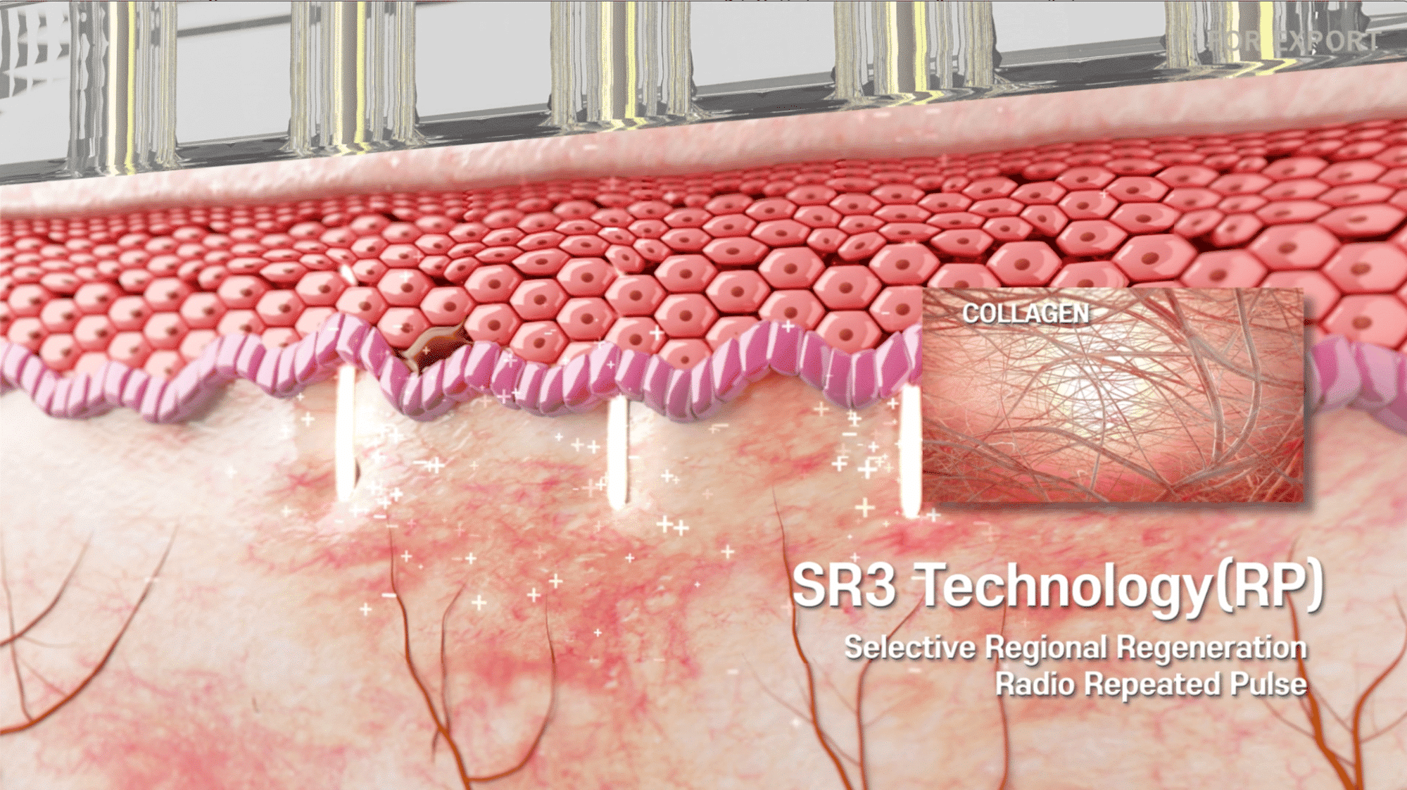 SR3 Technology RP Treatment - RF Microneedling Treatment