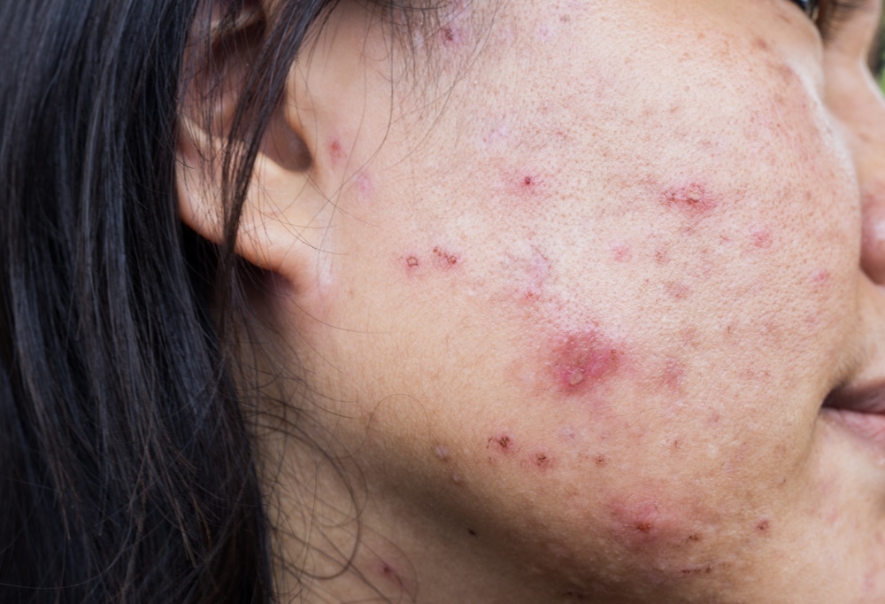 How do acne patches treat acne scars