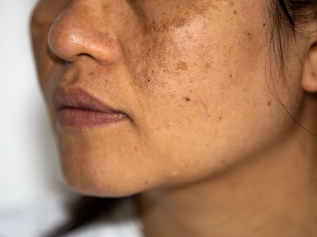 Oral vs Topical Treatment For Hyperpigmentation: Which Is Best? - SL  Aesthetic Clinic
