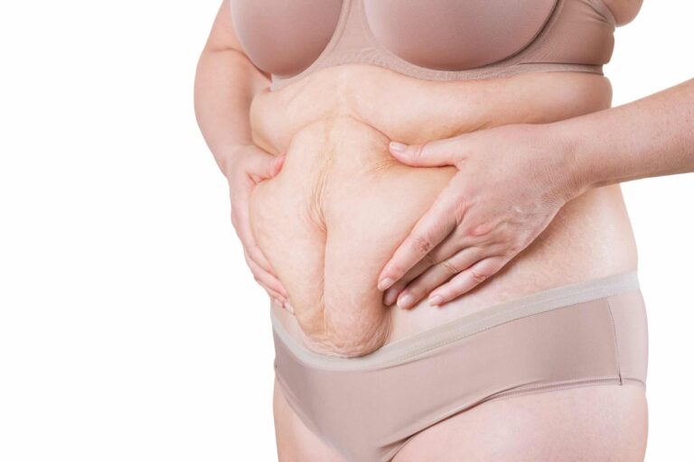 How To Treat Postpartum Saggy Skin