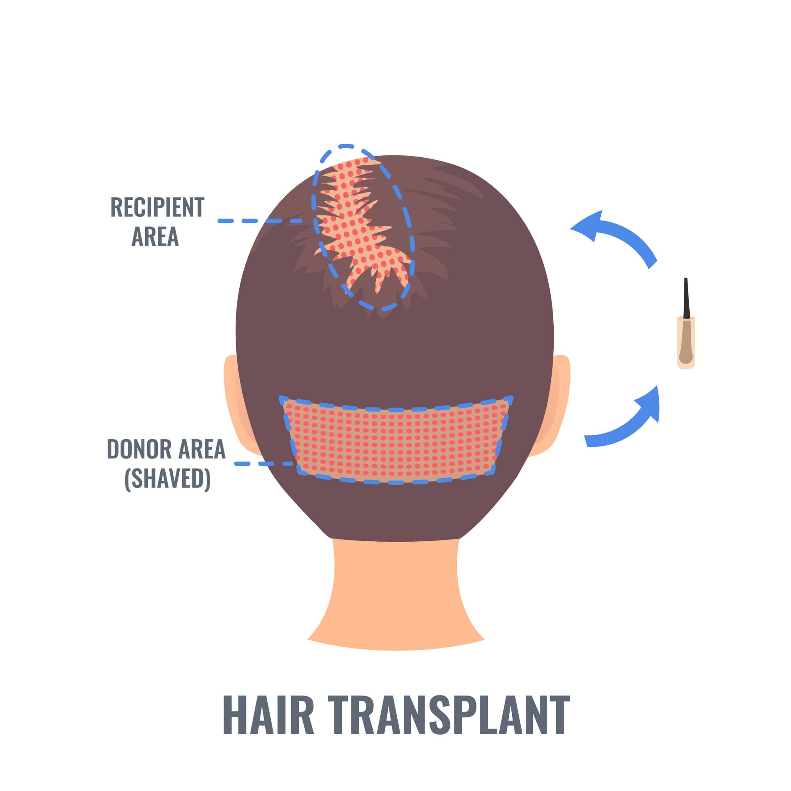Female hair tranplantation with FUE method