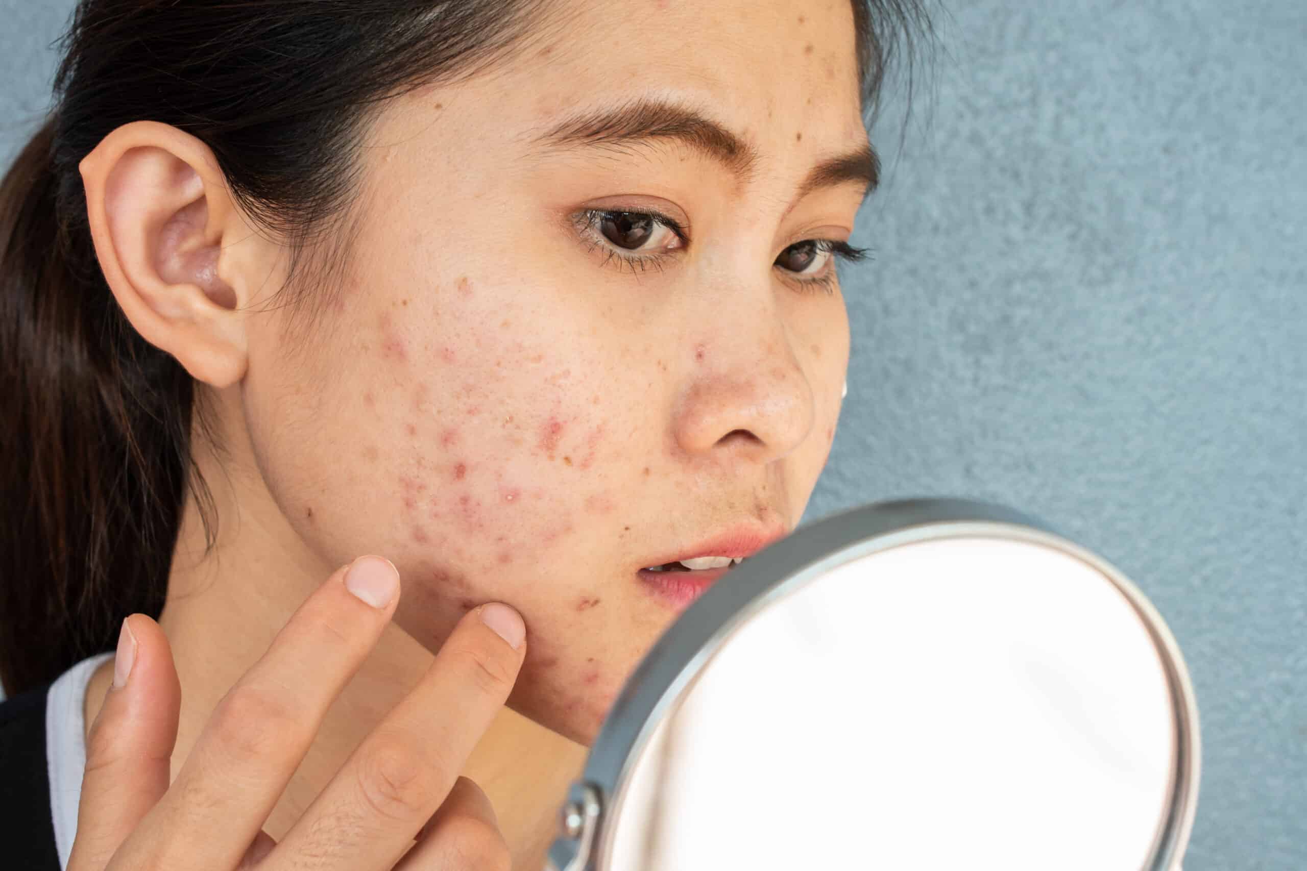 acne treatment singapore