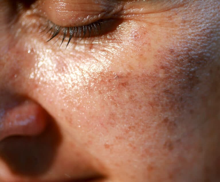 Pigmented spots on the face. Pigmentation on cheeks.