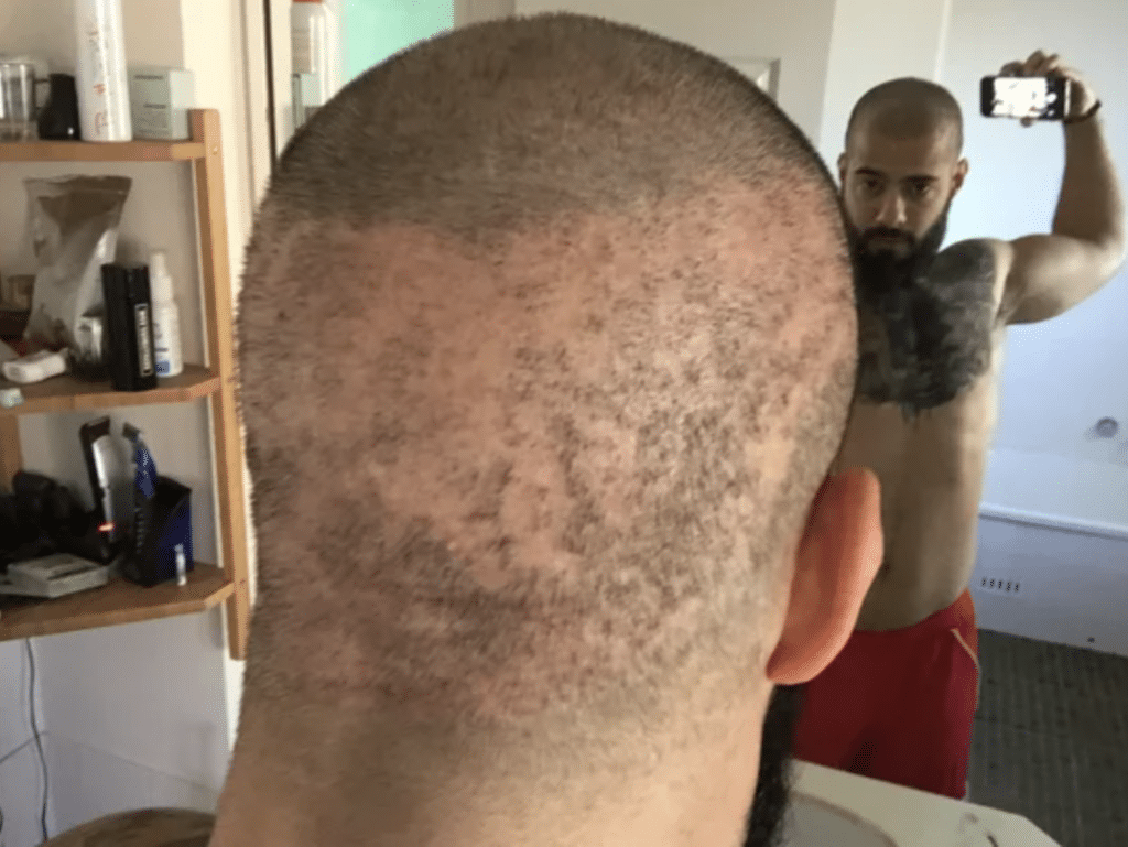 Male Hair Loss Problem