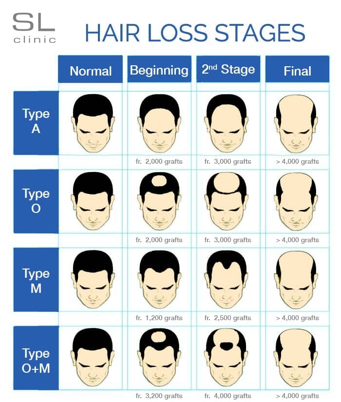 Hair Loss Stages - How Many Grafts Needed