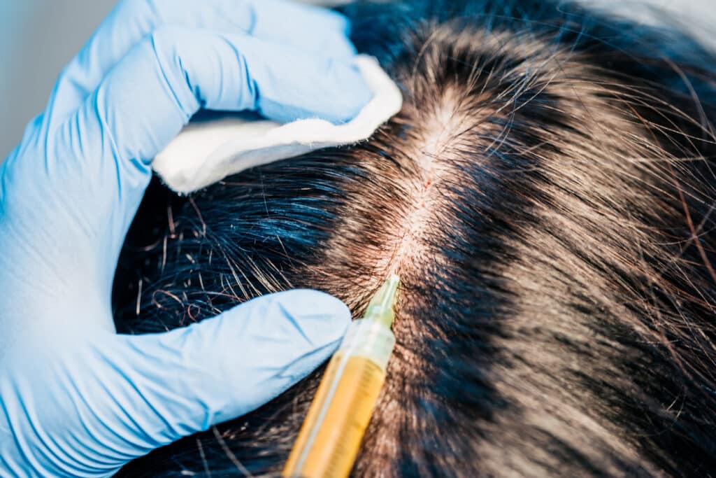 fue hair transplant in Singapore - hair transpalantation