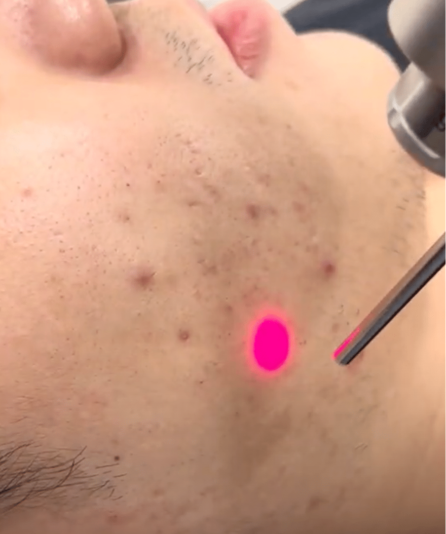 Are lasers always necessary for acne scar treatment