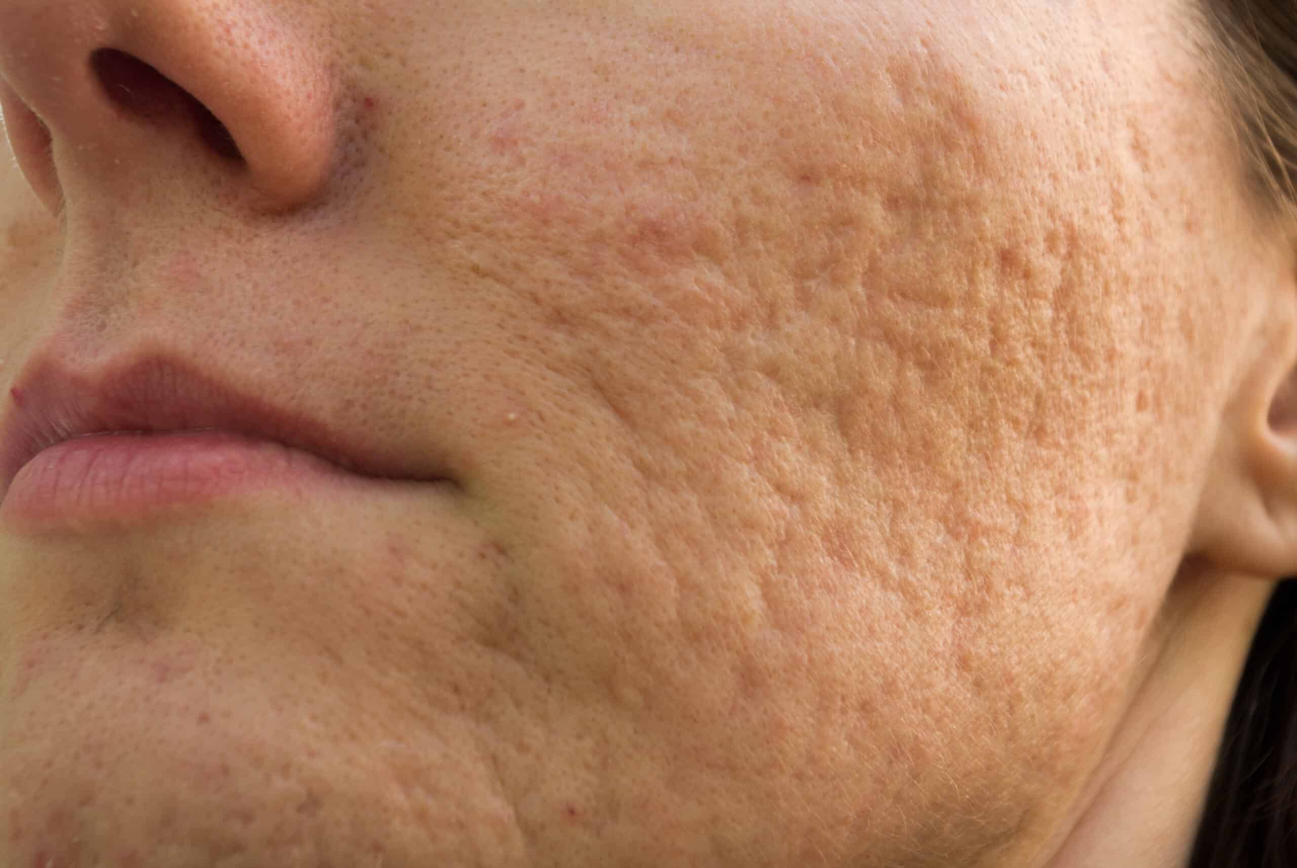 Laser Treatments for Acne Scars - Is it Bad