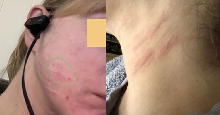 Swelling after Ultherapy - Is it Normal