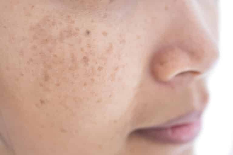 freckle on asian woman skin