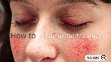 How to treat Demodex Mites