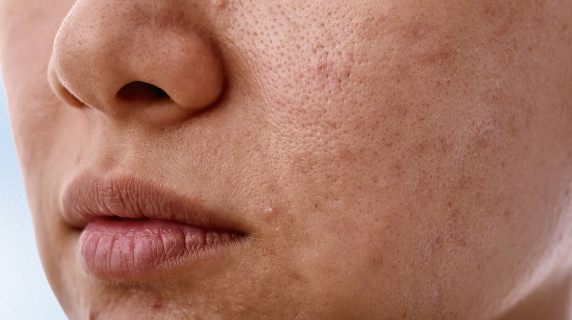 Enlarged Pores that needs Full Beam Laser Resurfacing