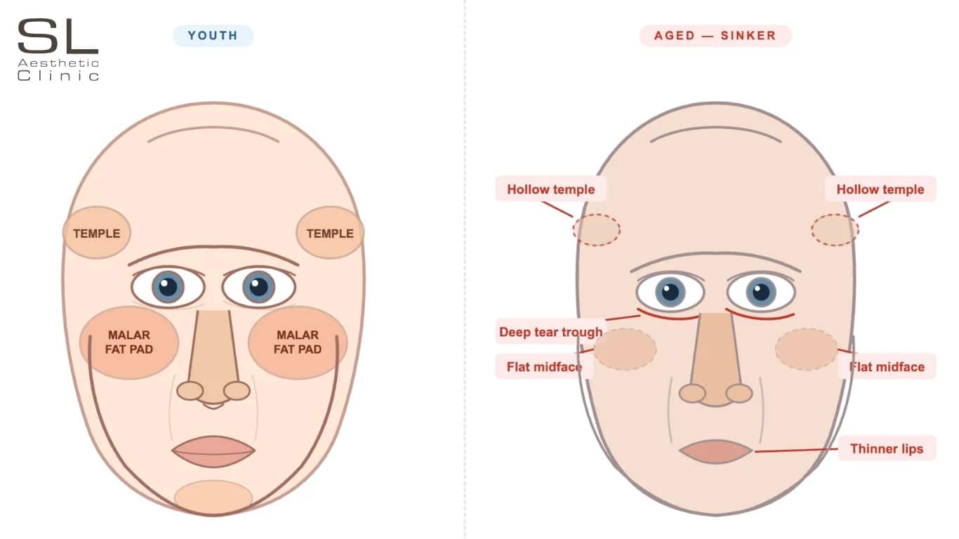 Illustration How a Youth Sinker Type Aged
