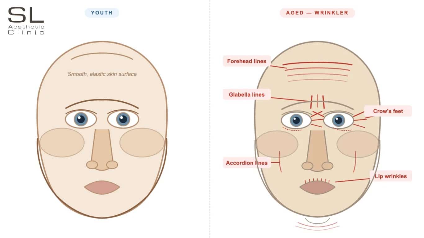 Illustration How a Youth Wrinkler Type Aged