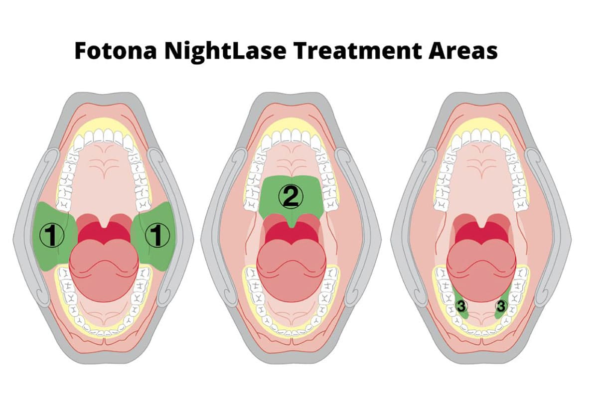 Fotona NightLase Treatment Areas in Mouth