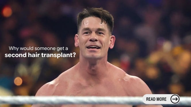 Why did John Cena get a second hair transplant?
