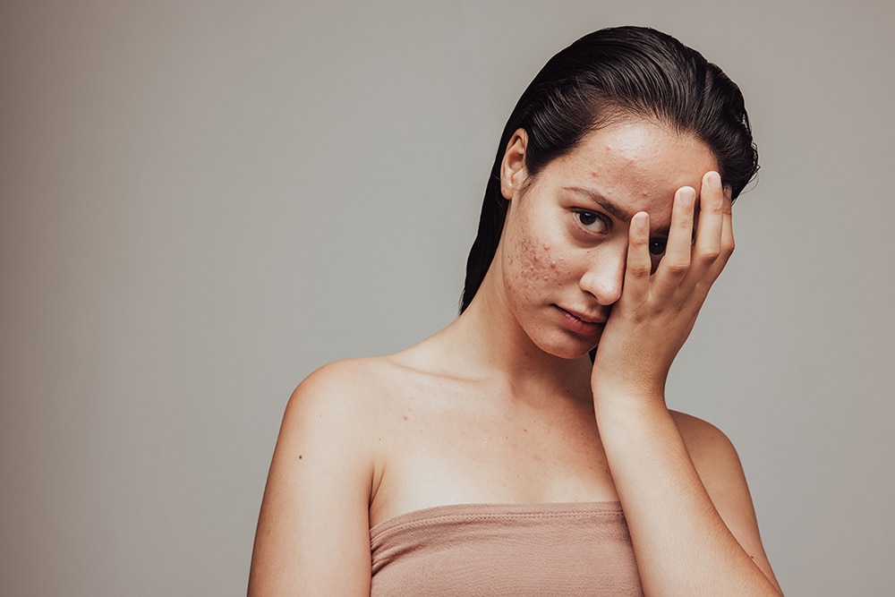 Covering your skin does not make the marks disappear. Know whether you have acne marks or structural scarring and get the right treatment in Singapore
