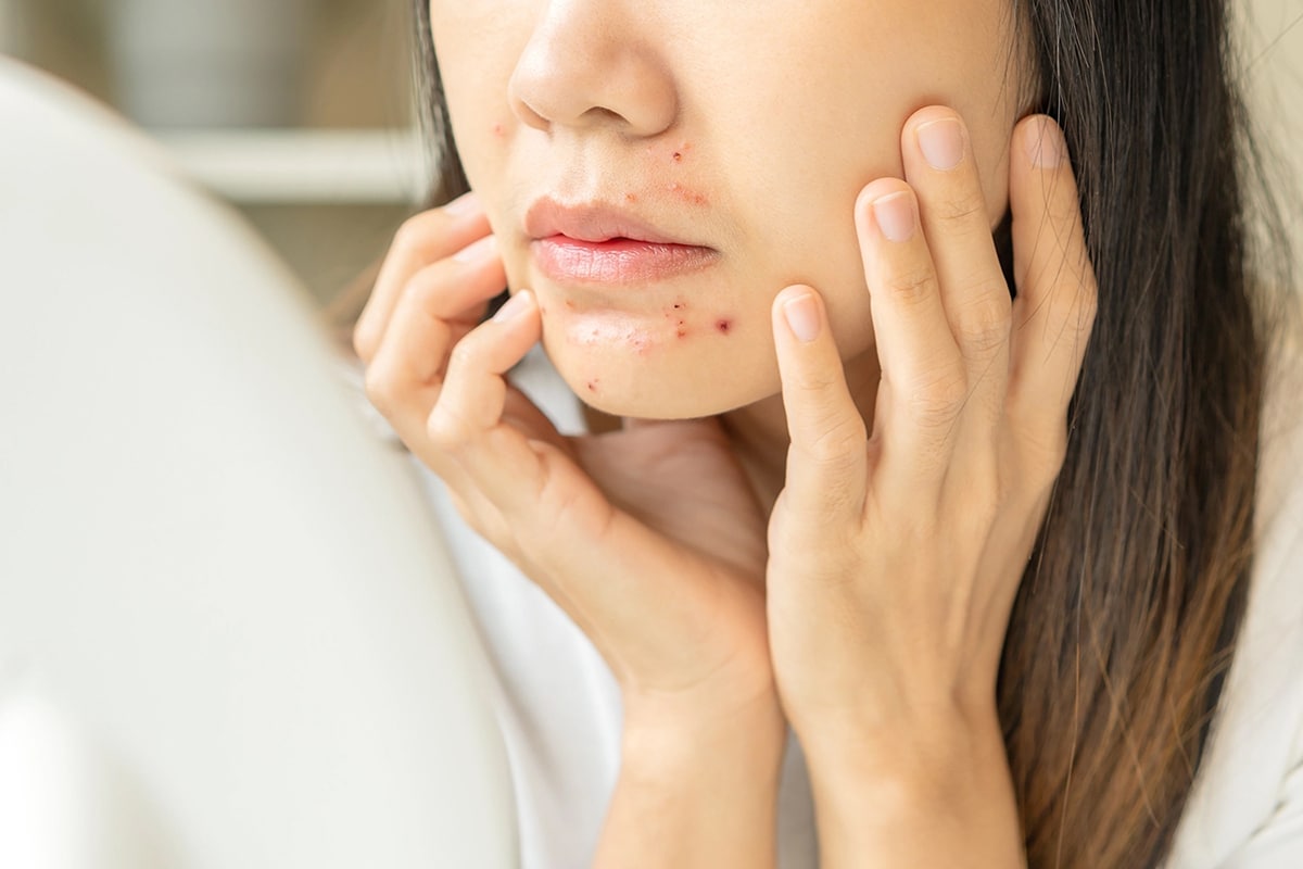 Woman with acne