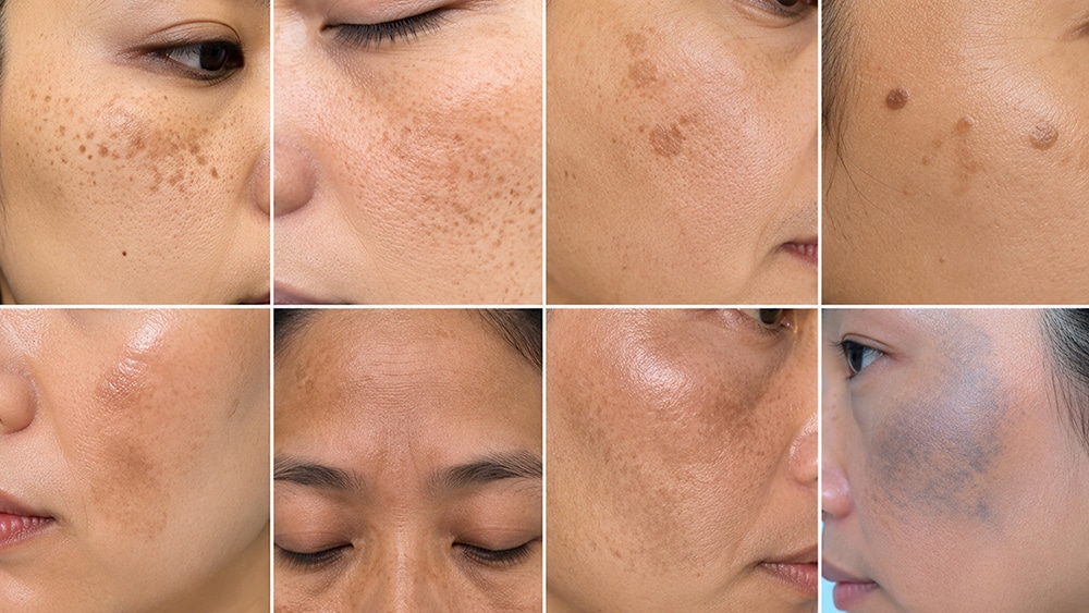 Facial pigmentation and uneven skin tone