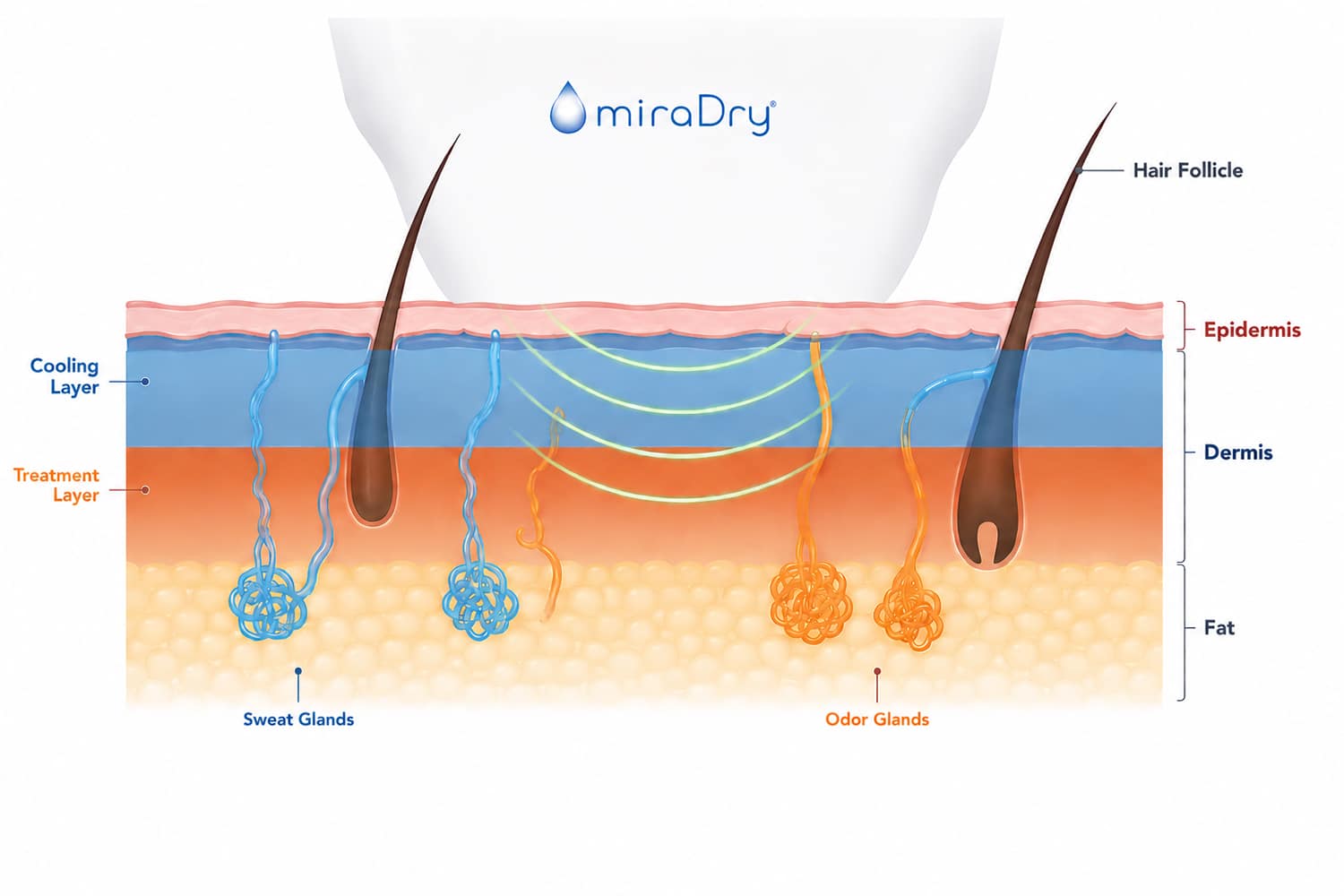 How Does miraDry Treatment Work for Underarm
