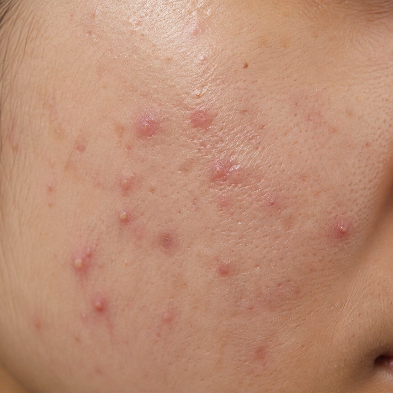 Acne prone-skin